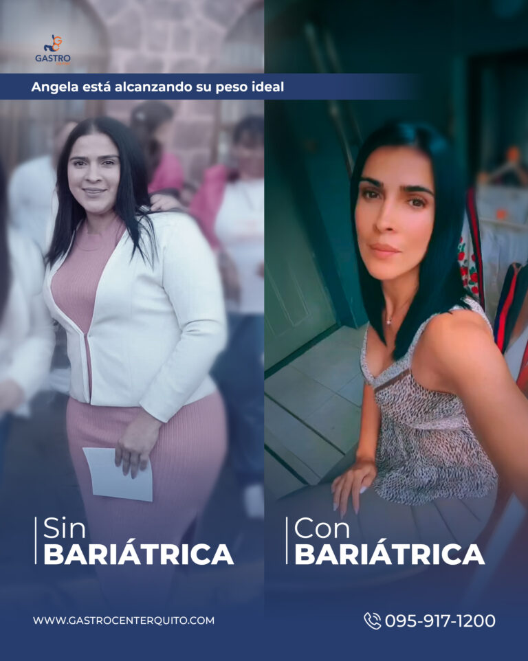 antes-después 1