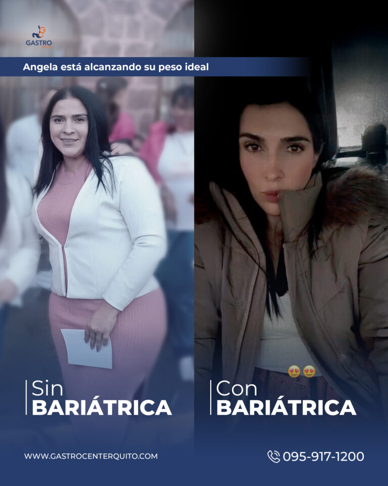 antes-después 2